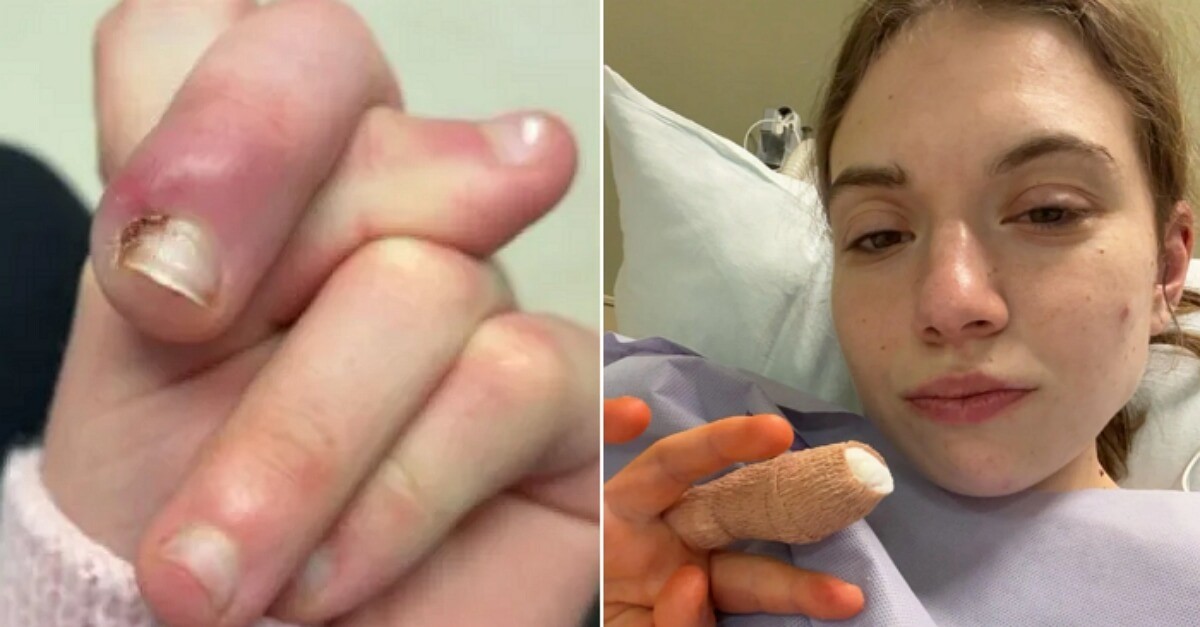 손톱 물어뜯는 습관이 부른 비극, 21살 여성이 '손가락 절단' 위기까지 간 사연